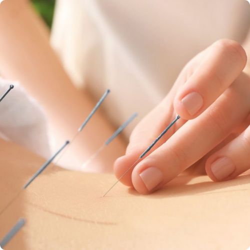 Acupuncture Needles